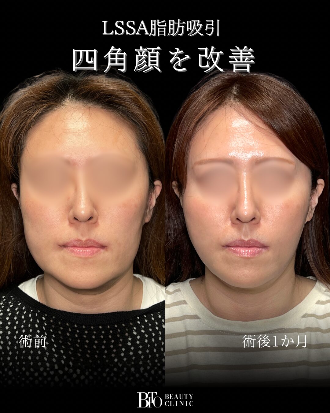 254.40代女性 顔のLSSA脂肪吸引