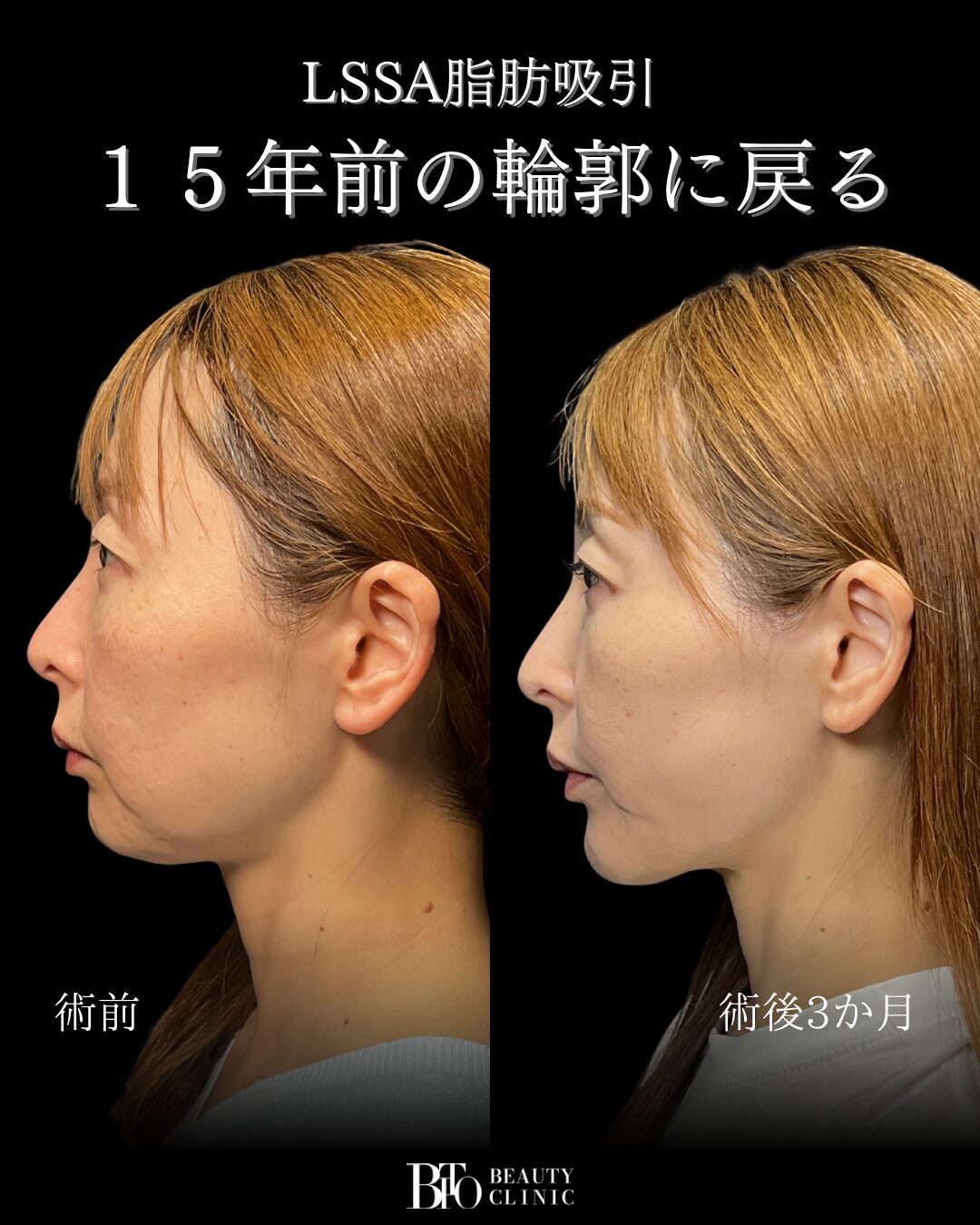 255.40代女性 顔のLSSA脂肪吸引