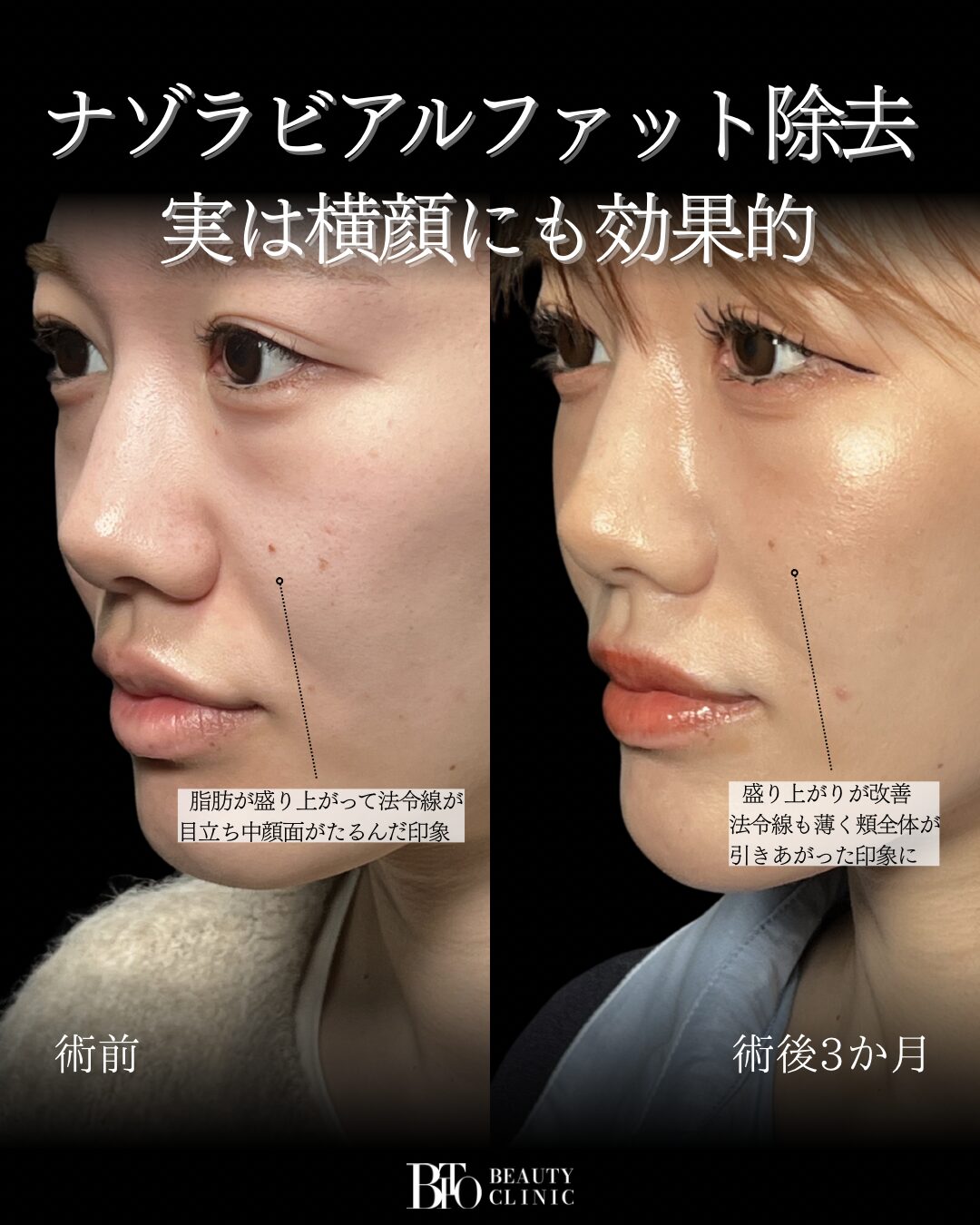 257.20代女性 顔のLSSA脂肪吸引