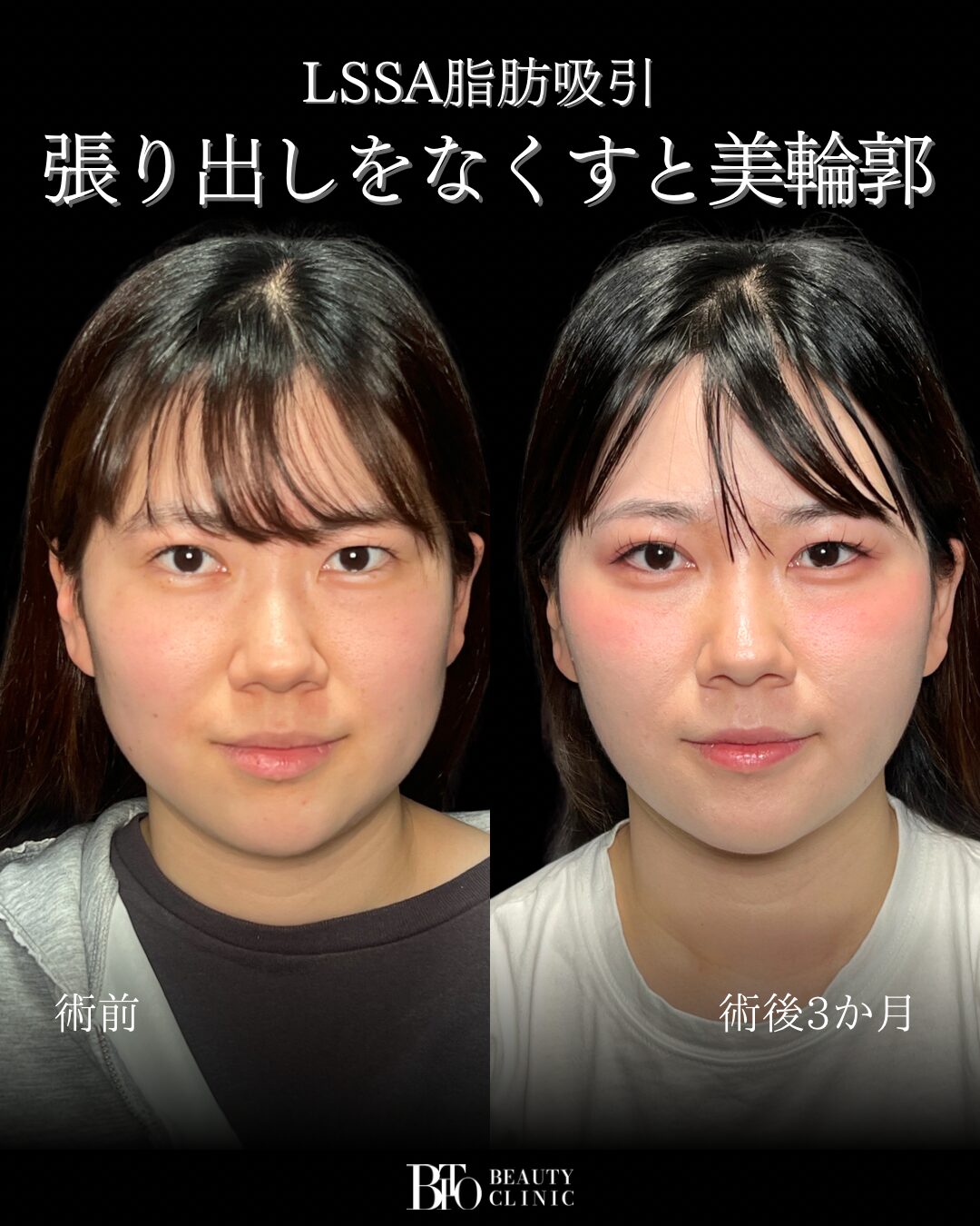 260.20代女性 顔のLSSA脂肪吸引
