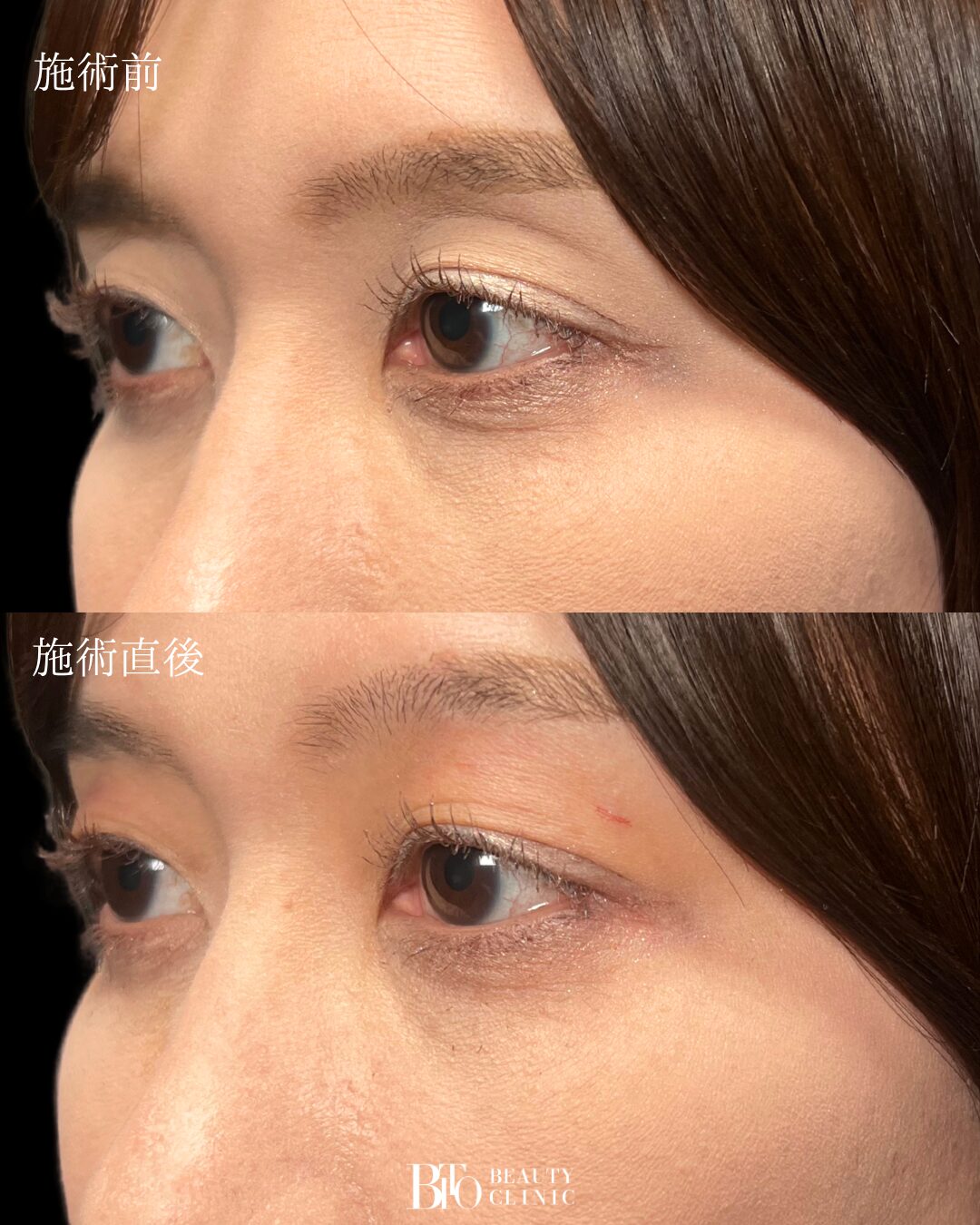 252.40代女性 くぼみ目のヒアルロン酸注入