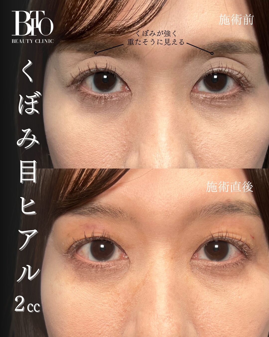252.40代女性 くぼみ目のヒアルロン酸注入