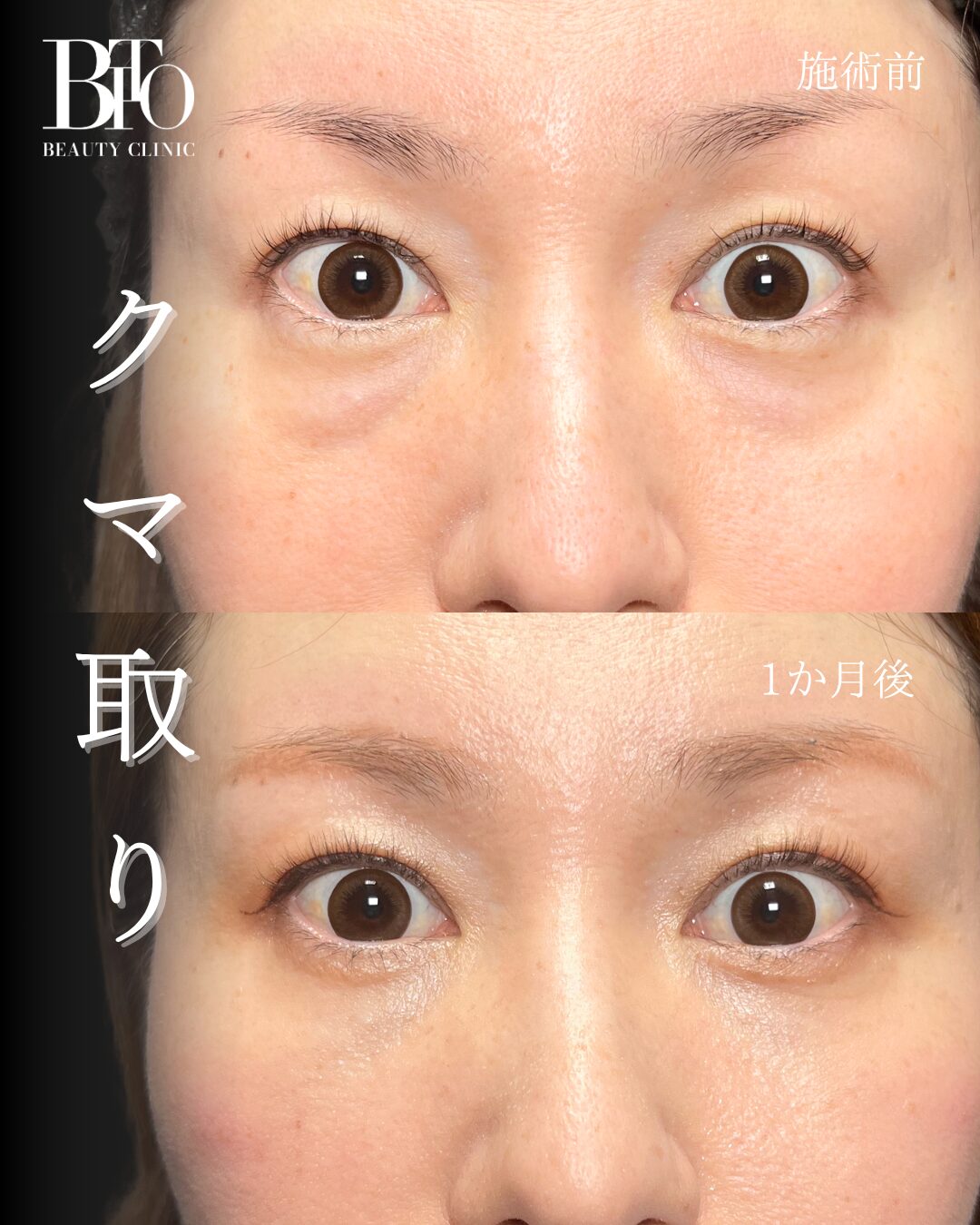 261.切らないクマ取り(脱脂術)