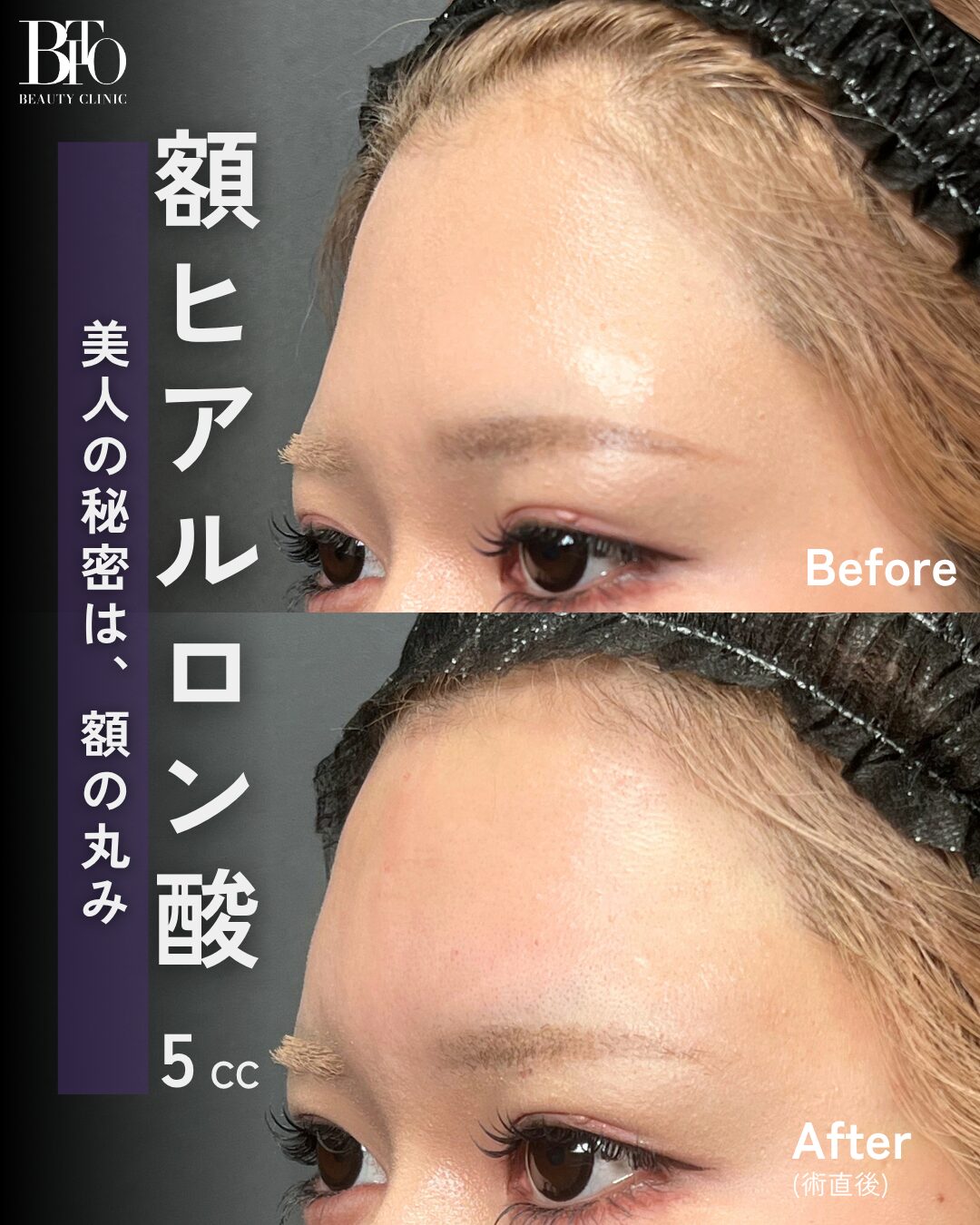 251.20代女性 額のヒアルロン酸注射