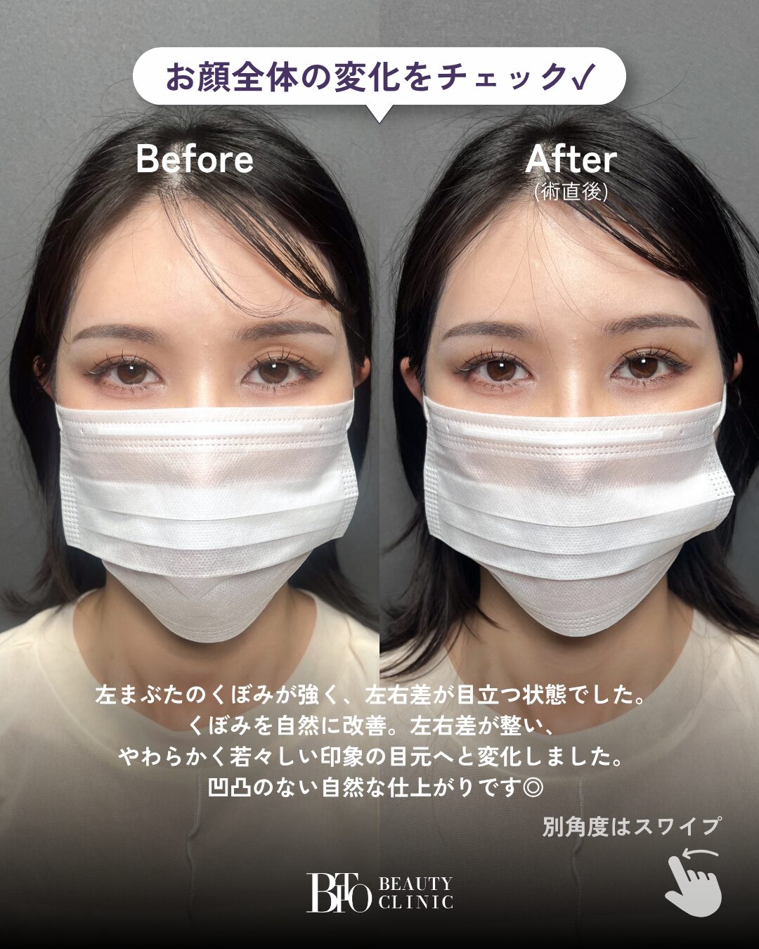 253.30代女性 くぼみ目のヒアルロン酸注入