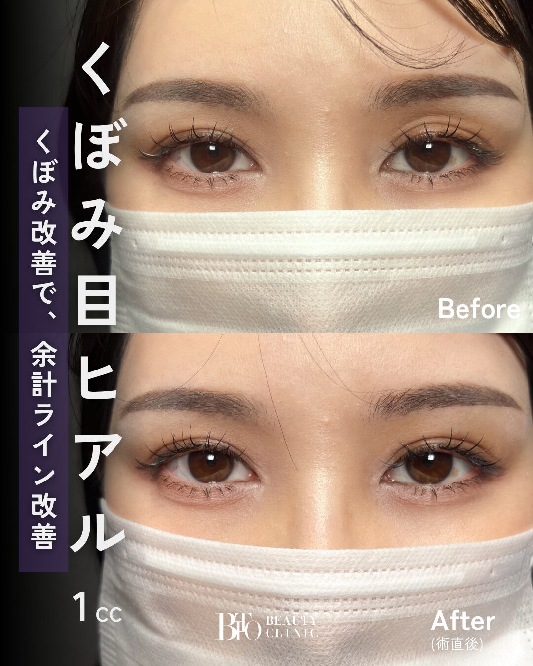 253.30代女性 くぼみ目のヒアルロン酸注入