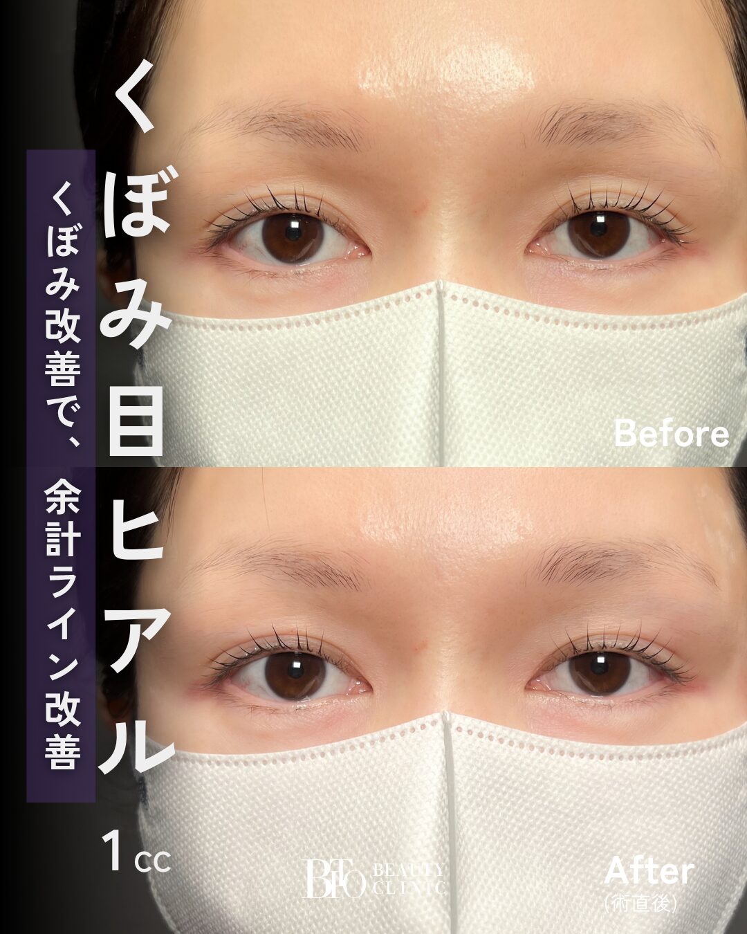 259.30代女性 くぼみ目のヒアルロン酸注入