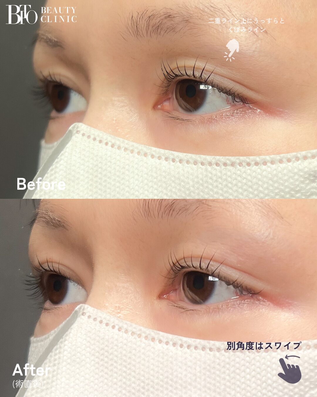 259.30代女性 くぼみ目のヒアルロン酸注入