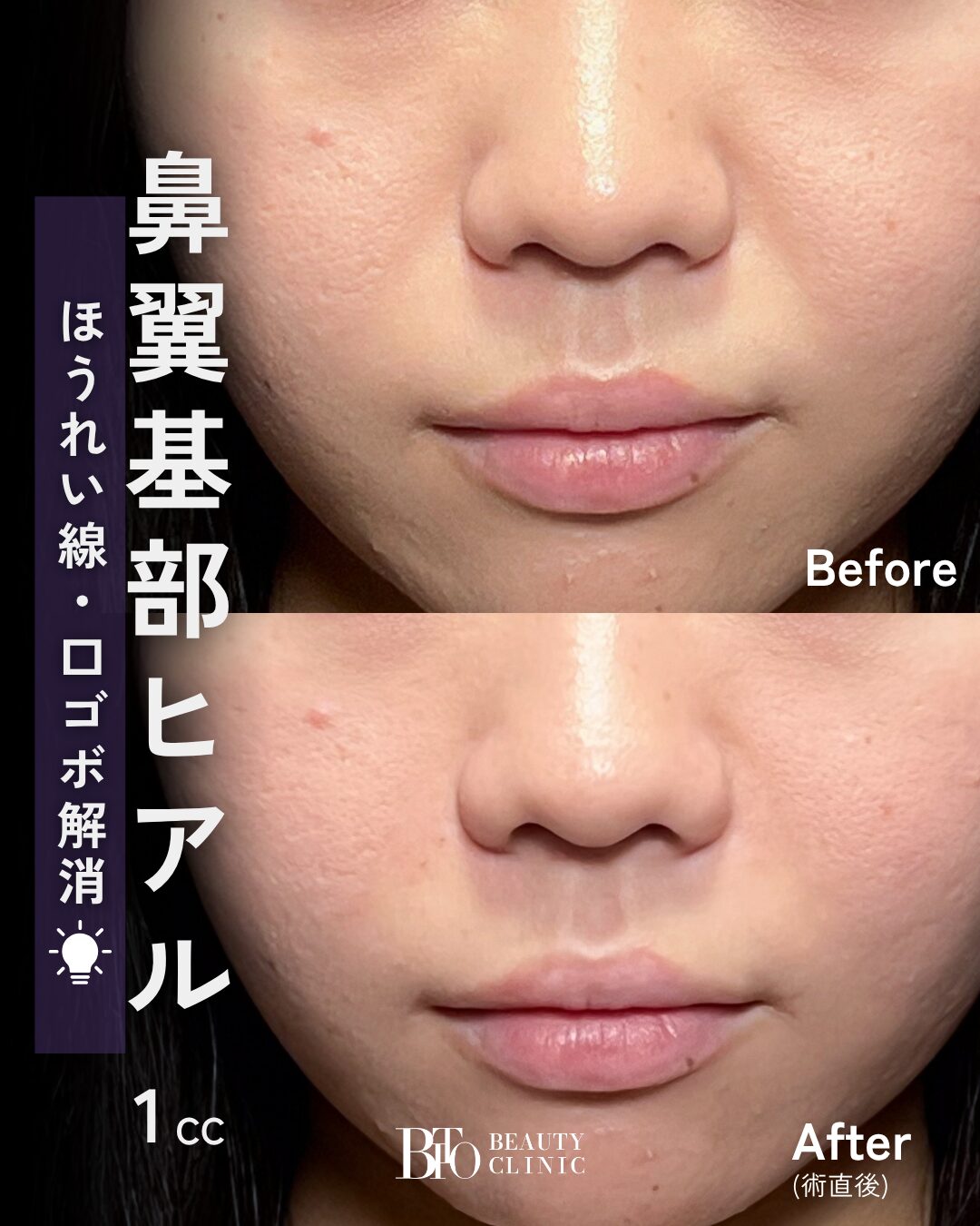 258.20代女性 鼻翼基部のヒアルロン酸注射