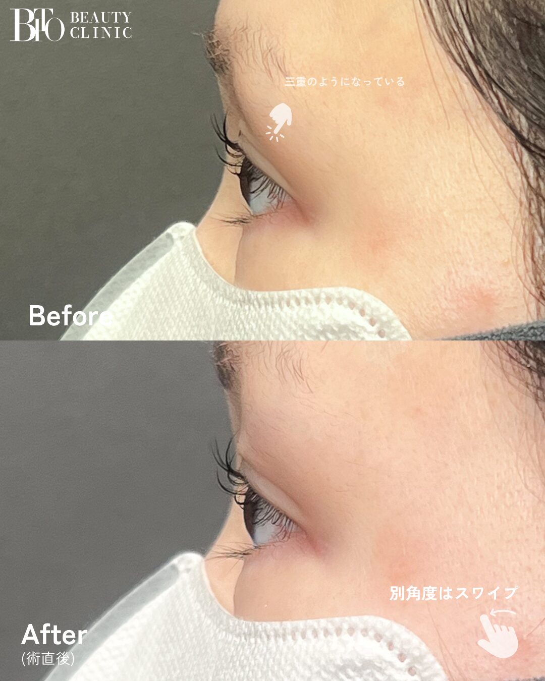 259.30代女性 くぼみ目のヒアルロン酸注入