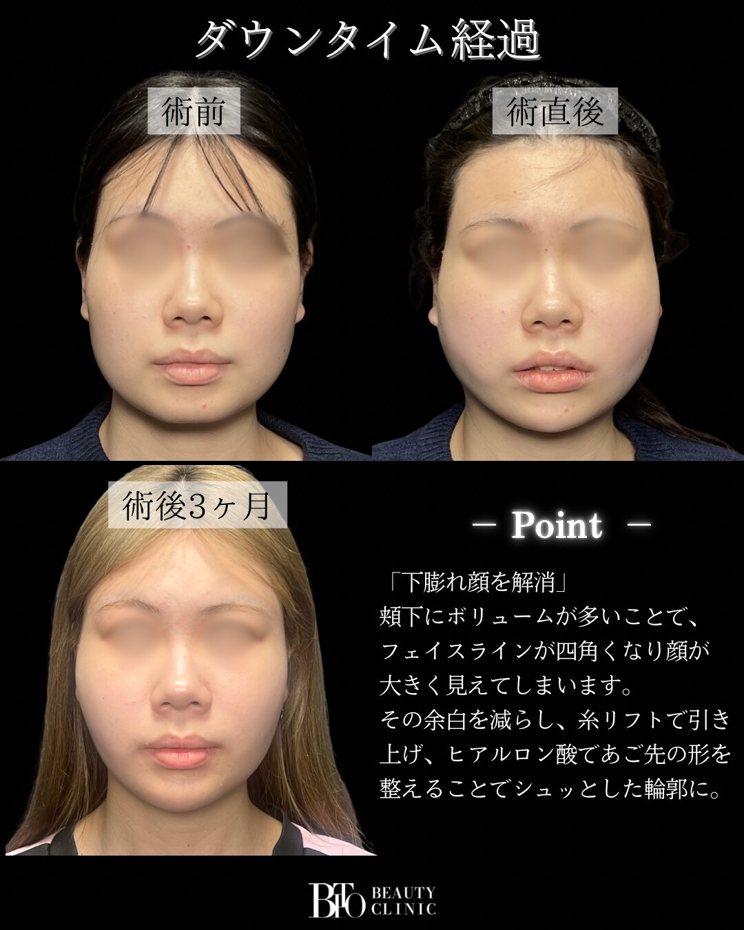 281.顔のLSSA脂肪吸引