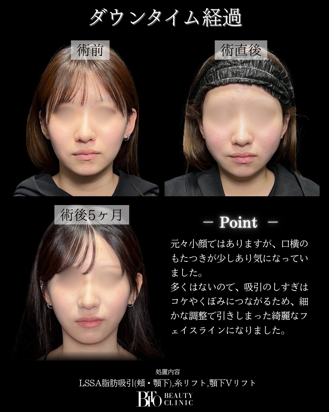 282.顔のLSSA脂肪吸引