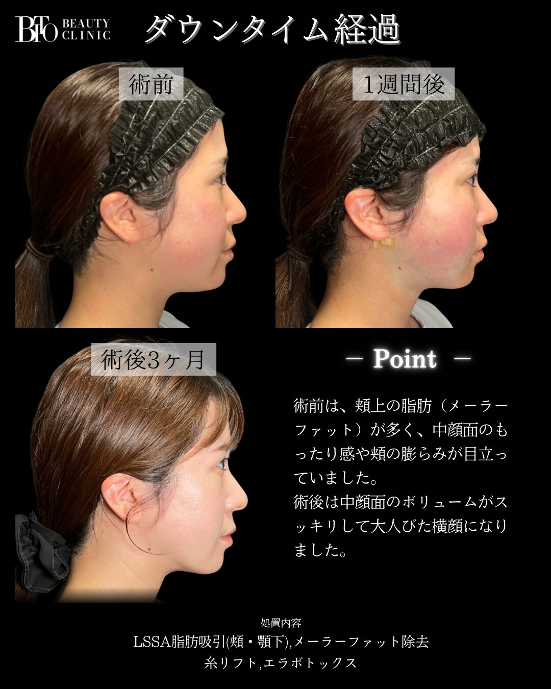 283.30代女性 顔の脂肪吸引