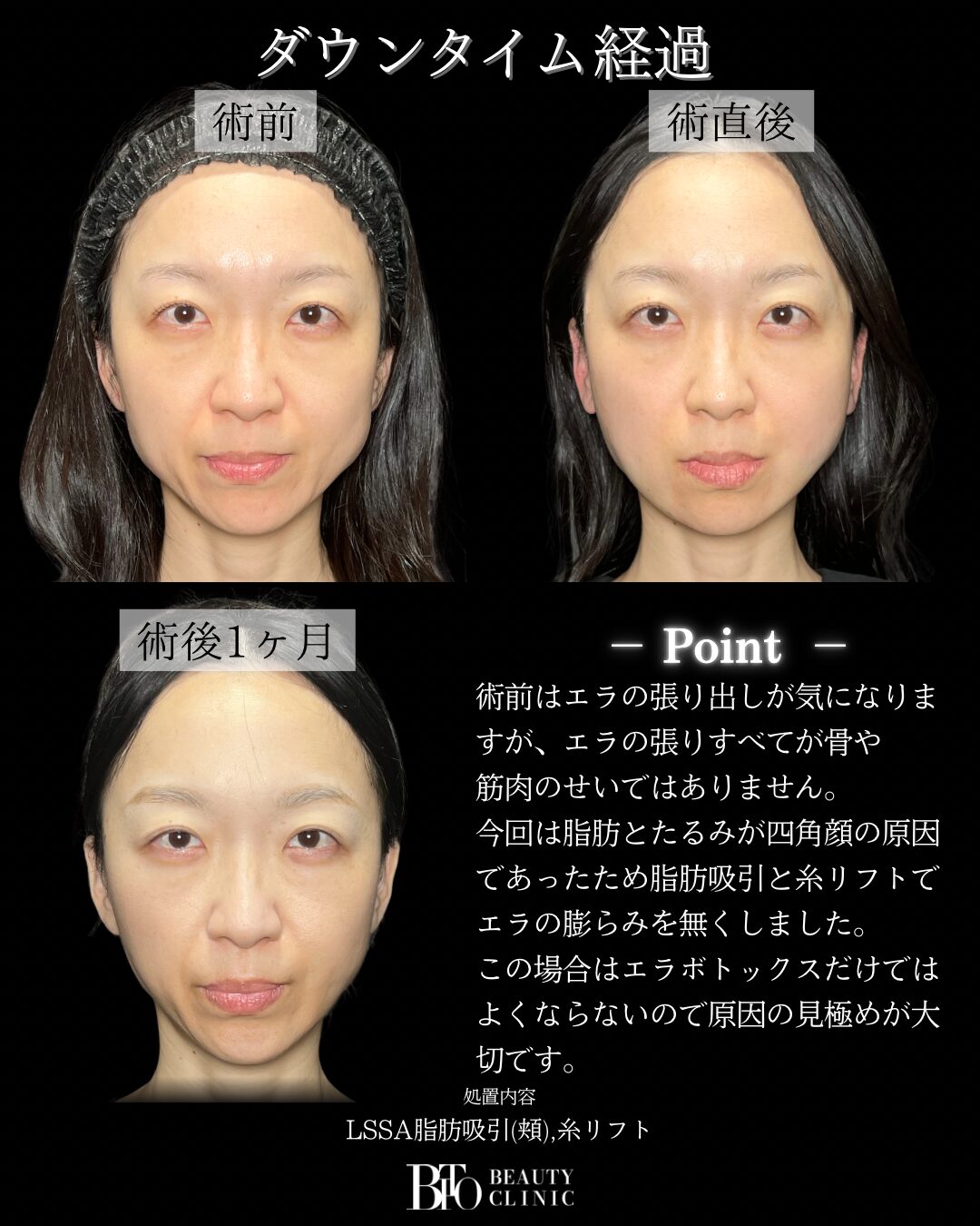 285.40代女性 顔のLSSA脂肪吸引