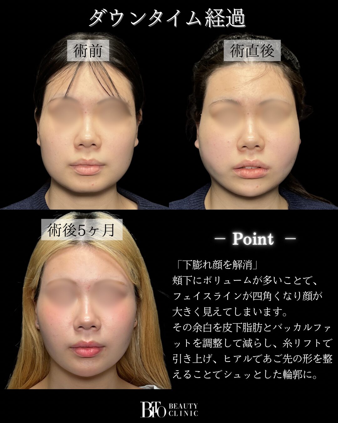 286.10代女性顔のLSSA脂肪吸引