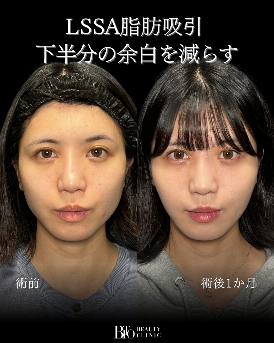 280.顔の脂肪吸引