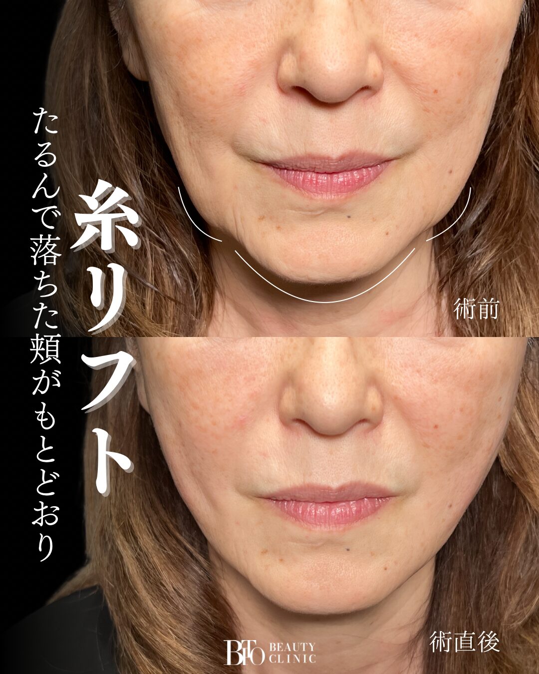 279.60代女性 糸リフト