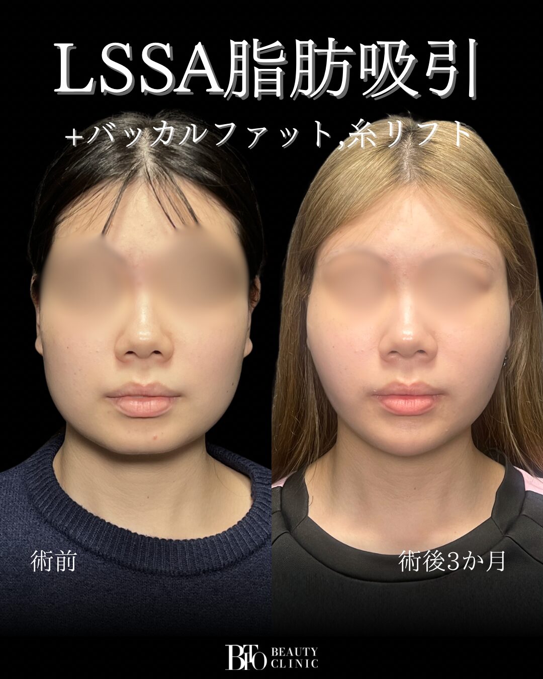 281.顔のLSSA脂肪吸引