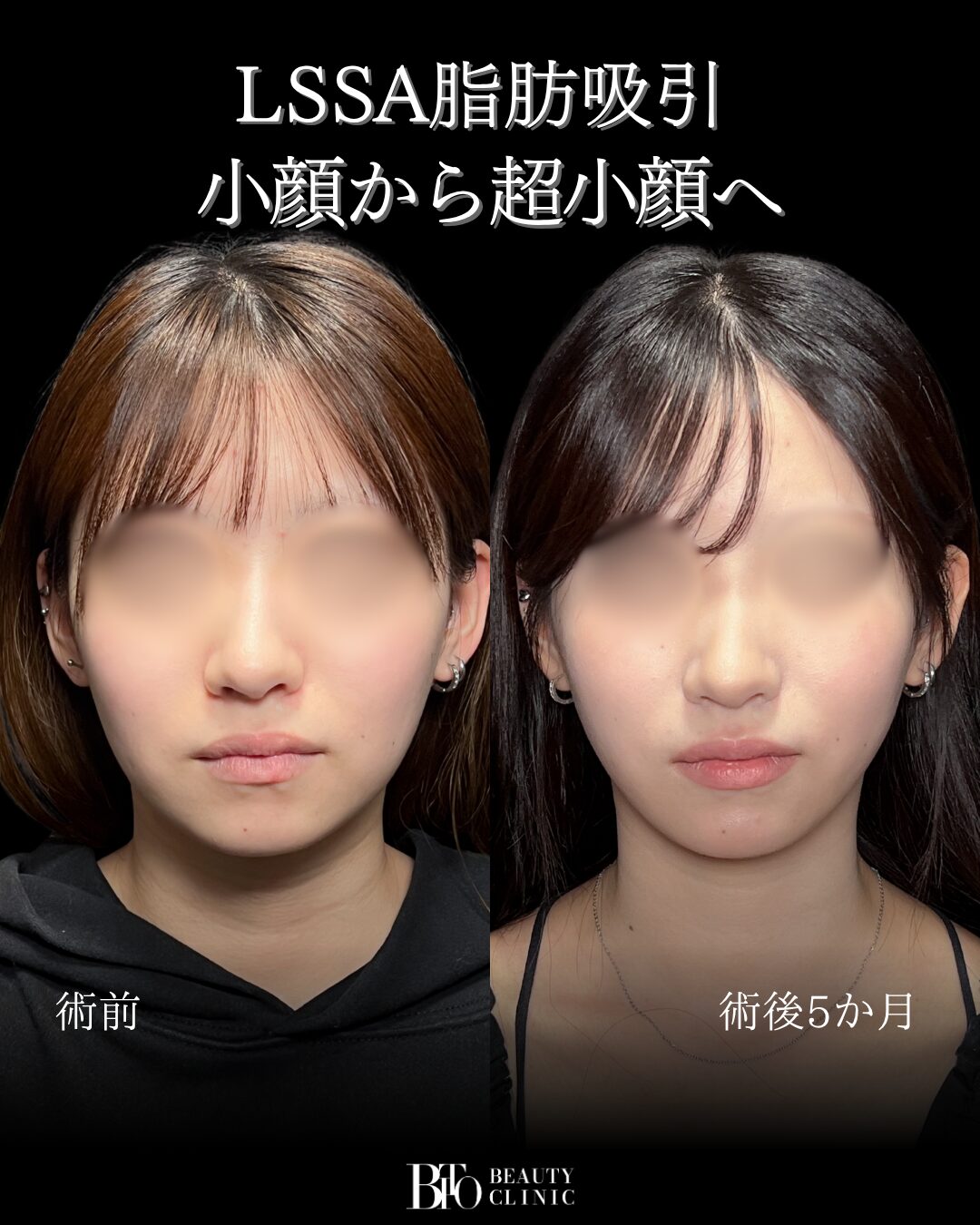 282.顔のLSSA脂肪吸引