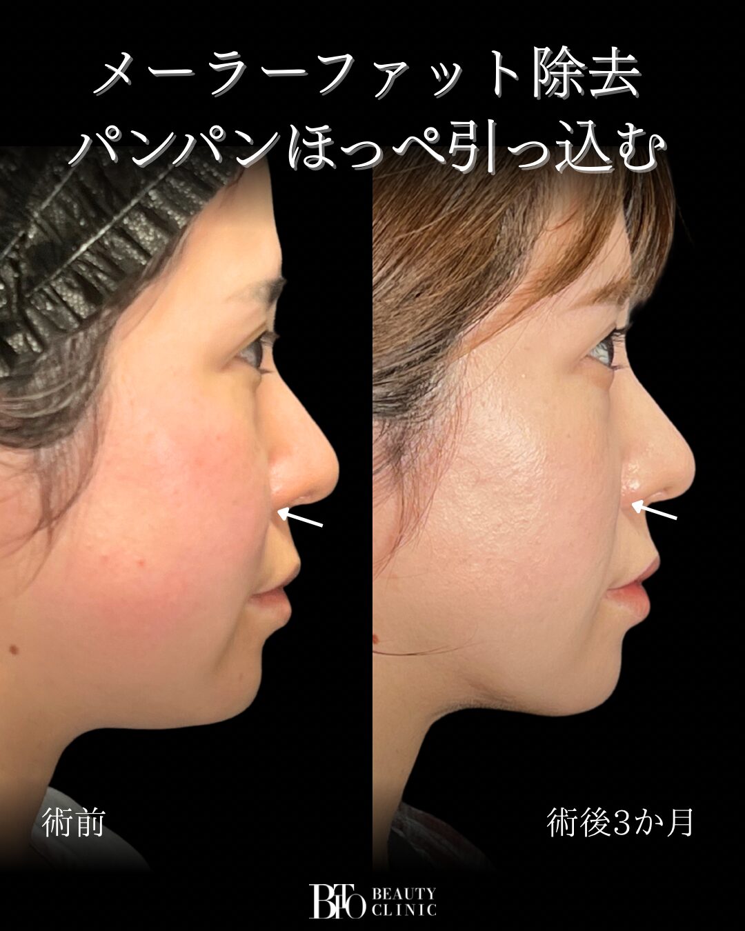 283.30代女性 顔の脂肪吸引