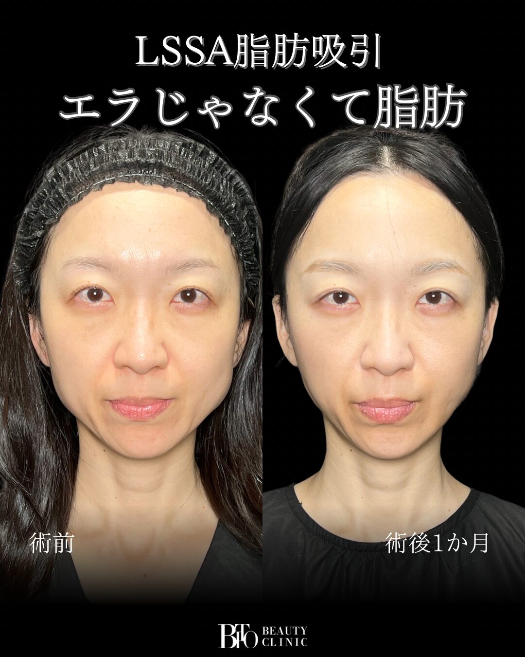 285.40代女性 顔のLSSA脂肪吸引