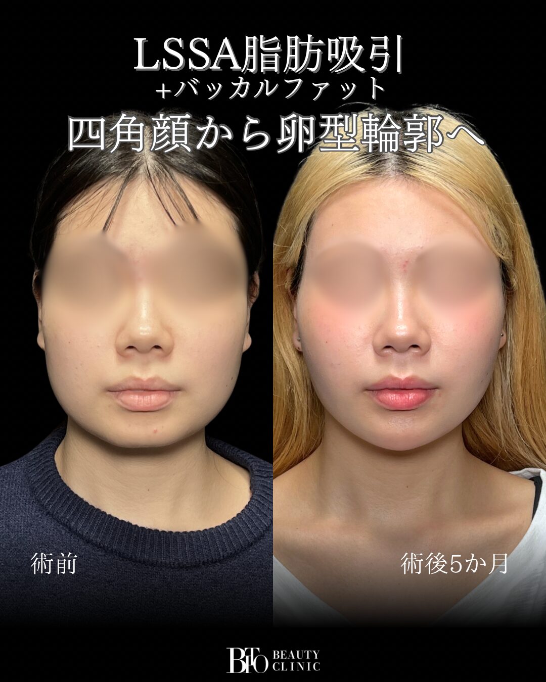 286.10代女性顔のLSSA脂肪吸引