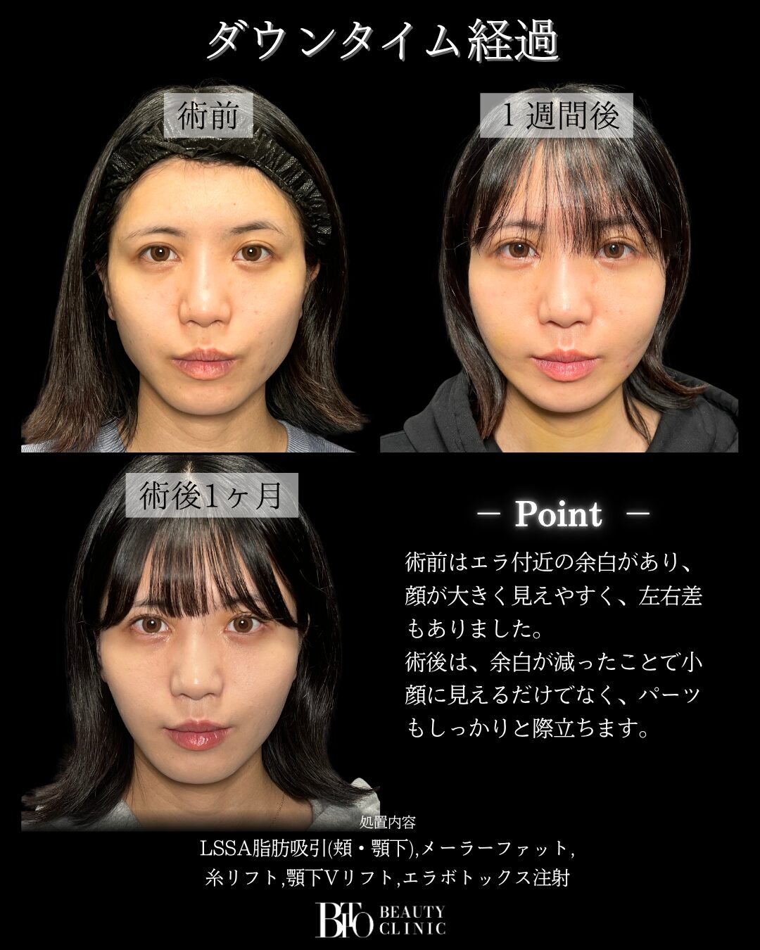 280.顔の脂肪吸引