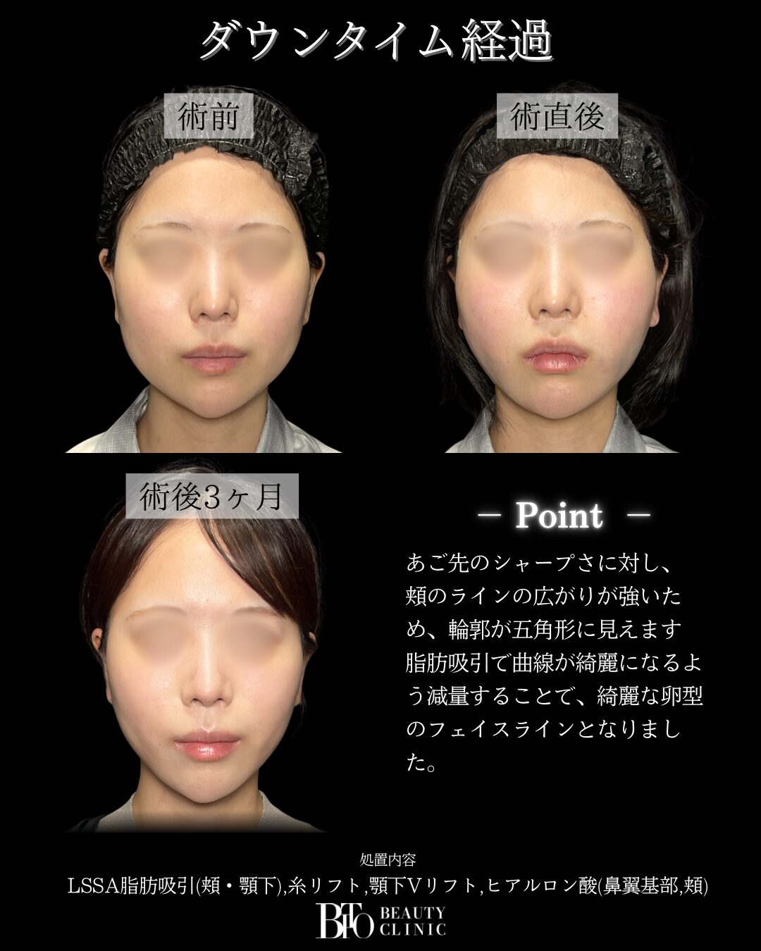 280.20代女性 顔のLSSA脂肪吸引