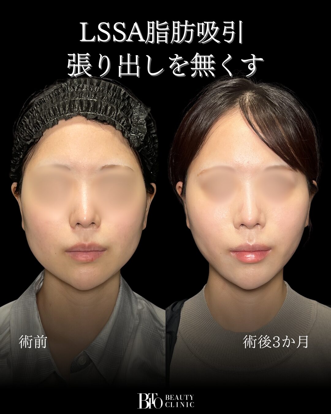 280.20代女性 顔のLSSA脂肪吸引