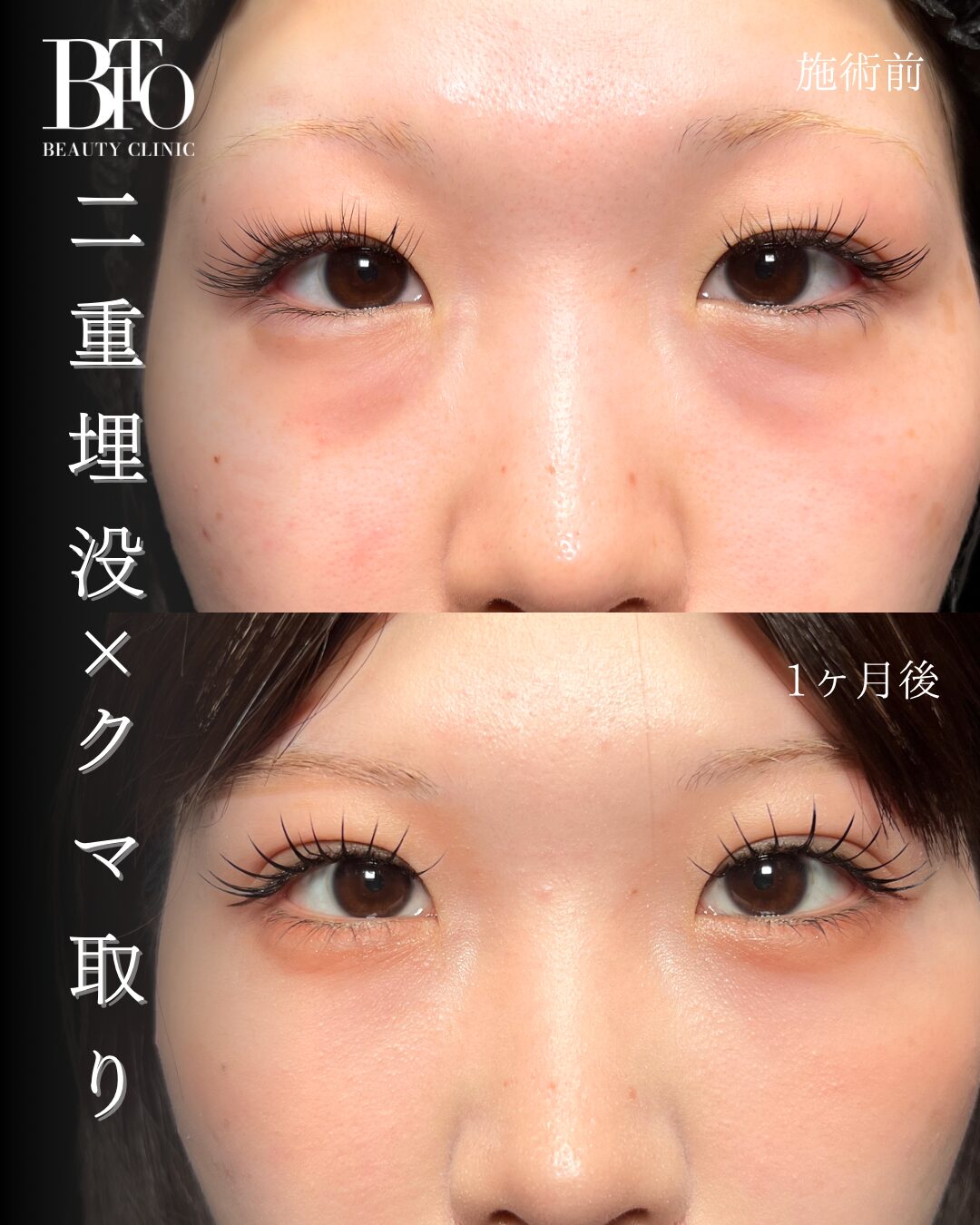 274.20代女性 切らないクマ取り(脱脂術)・二重埋没