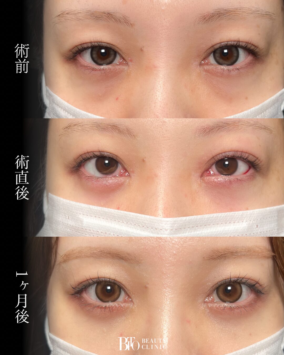 265.20代女性 切らないクマ取り(脱脂術)