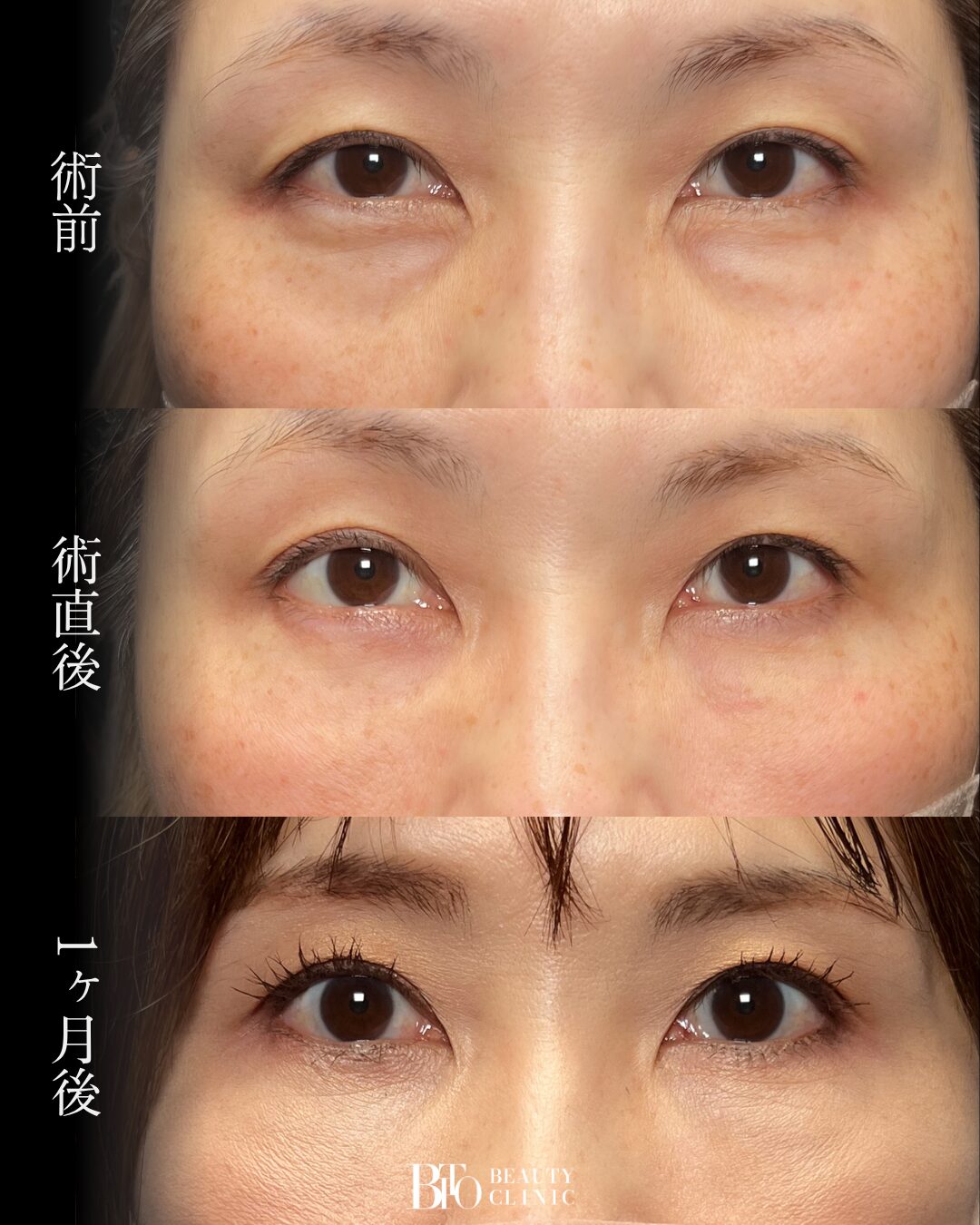 273.切らないクマ取り(脱脂術)