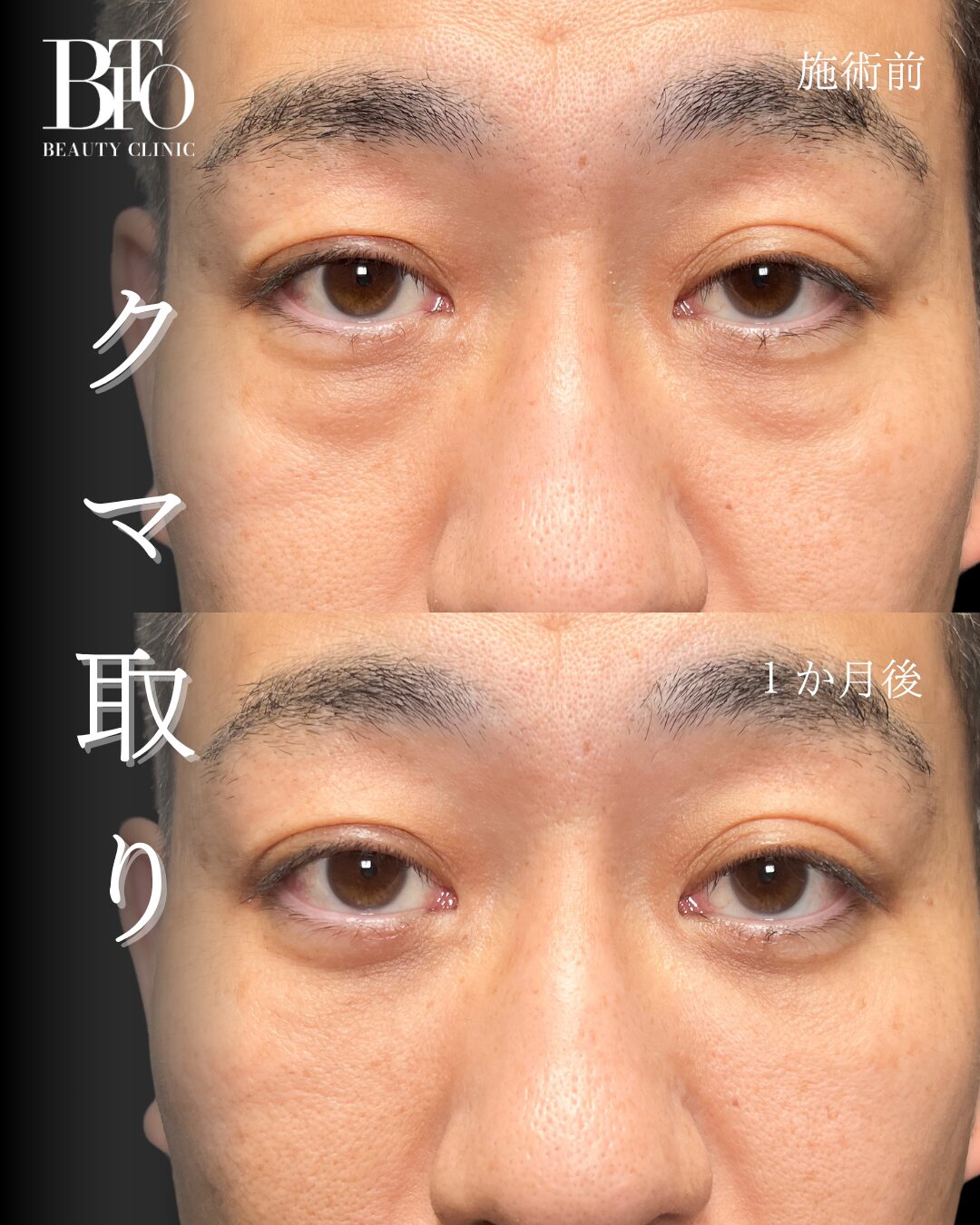 270.40代男性 切らないクマ取り(脱脂術)