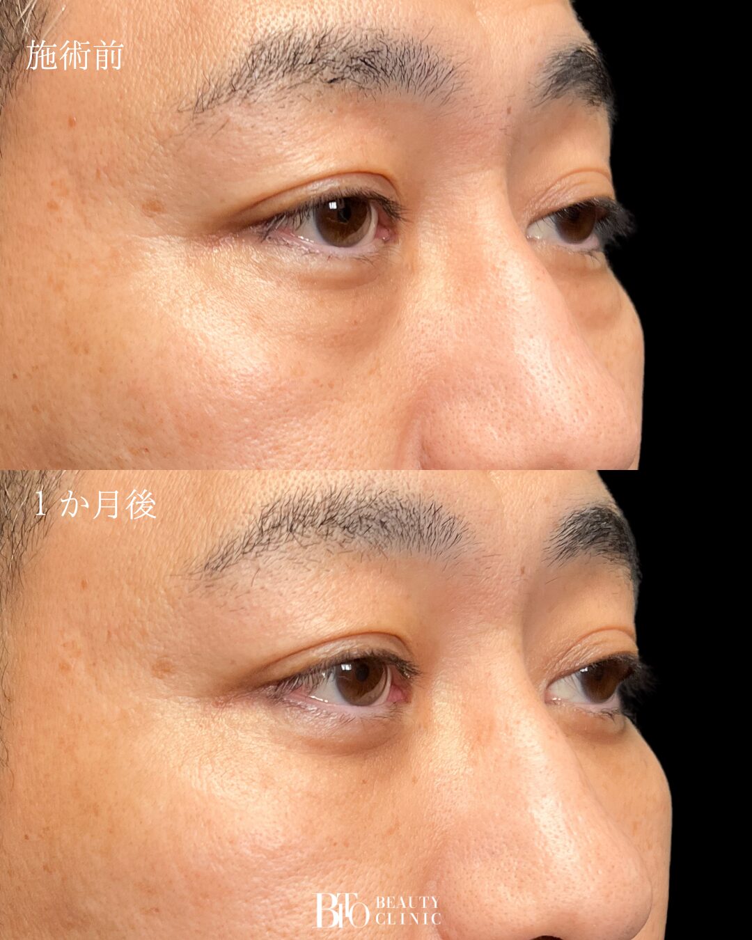 270.40代男性 切らないクマ取り(脱脂術)
