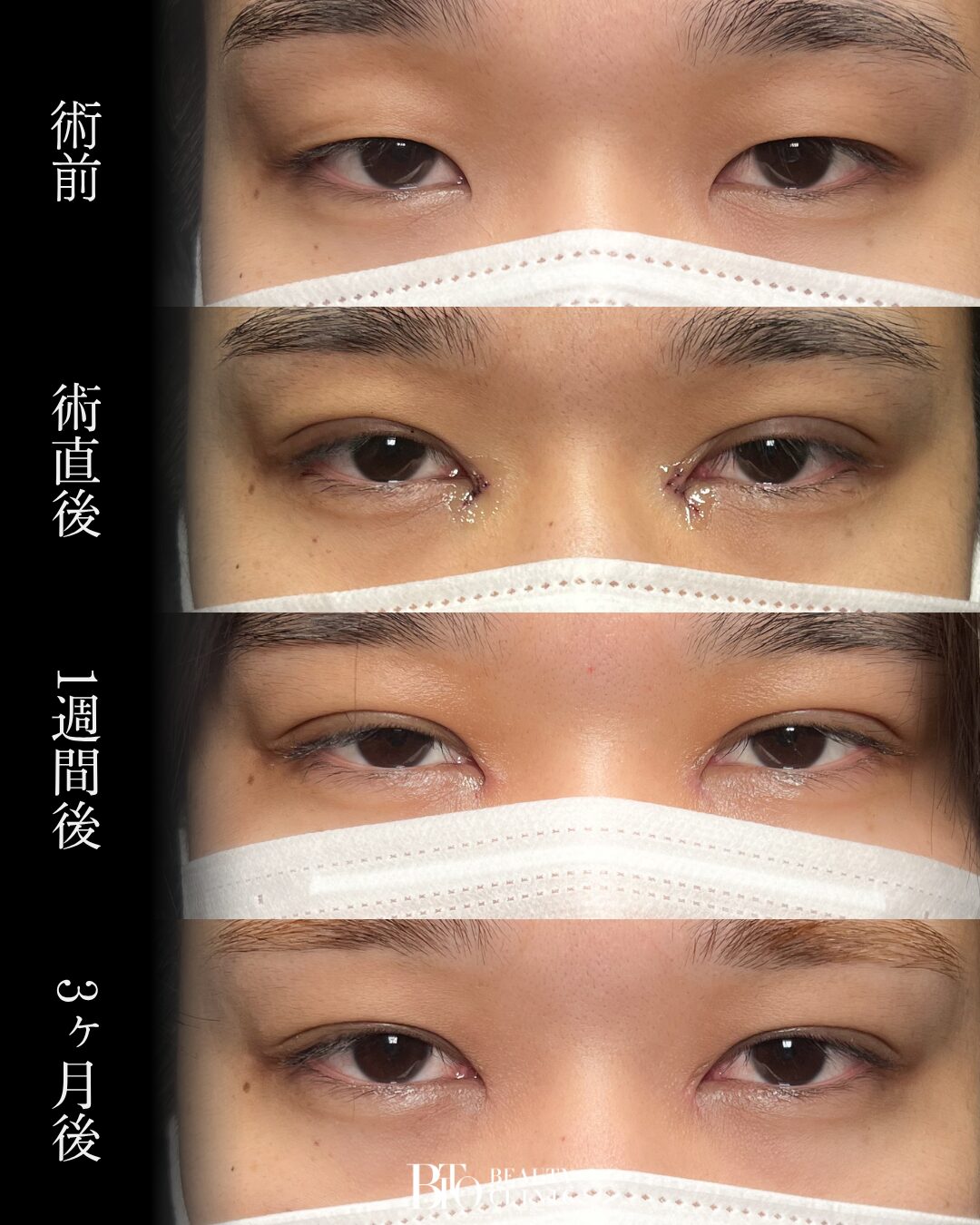 269. 20代男性 二重埋没・目頭切開