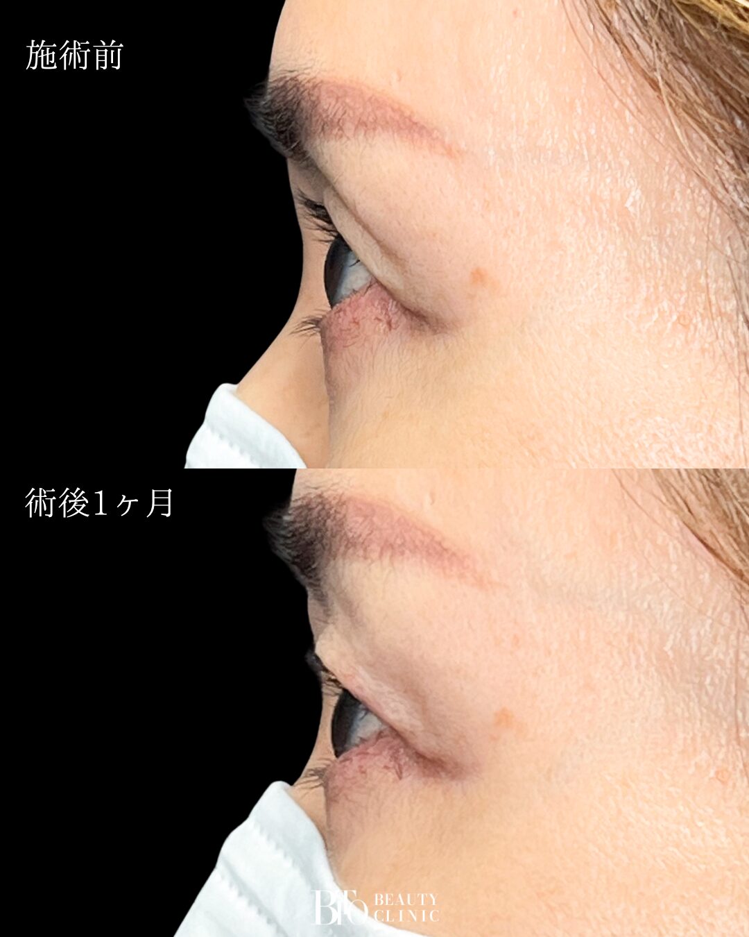 272.50代女性 くぼみ目のヒアルロン酸注入