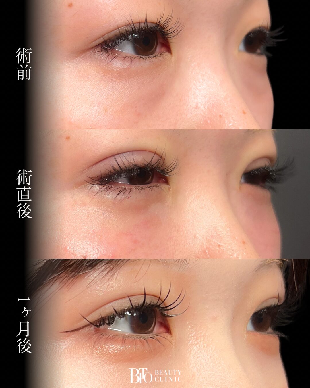 274.20代女性 切らないクマ取り(脱脂術)・二重埋没
