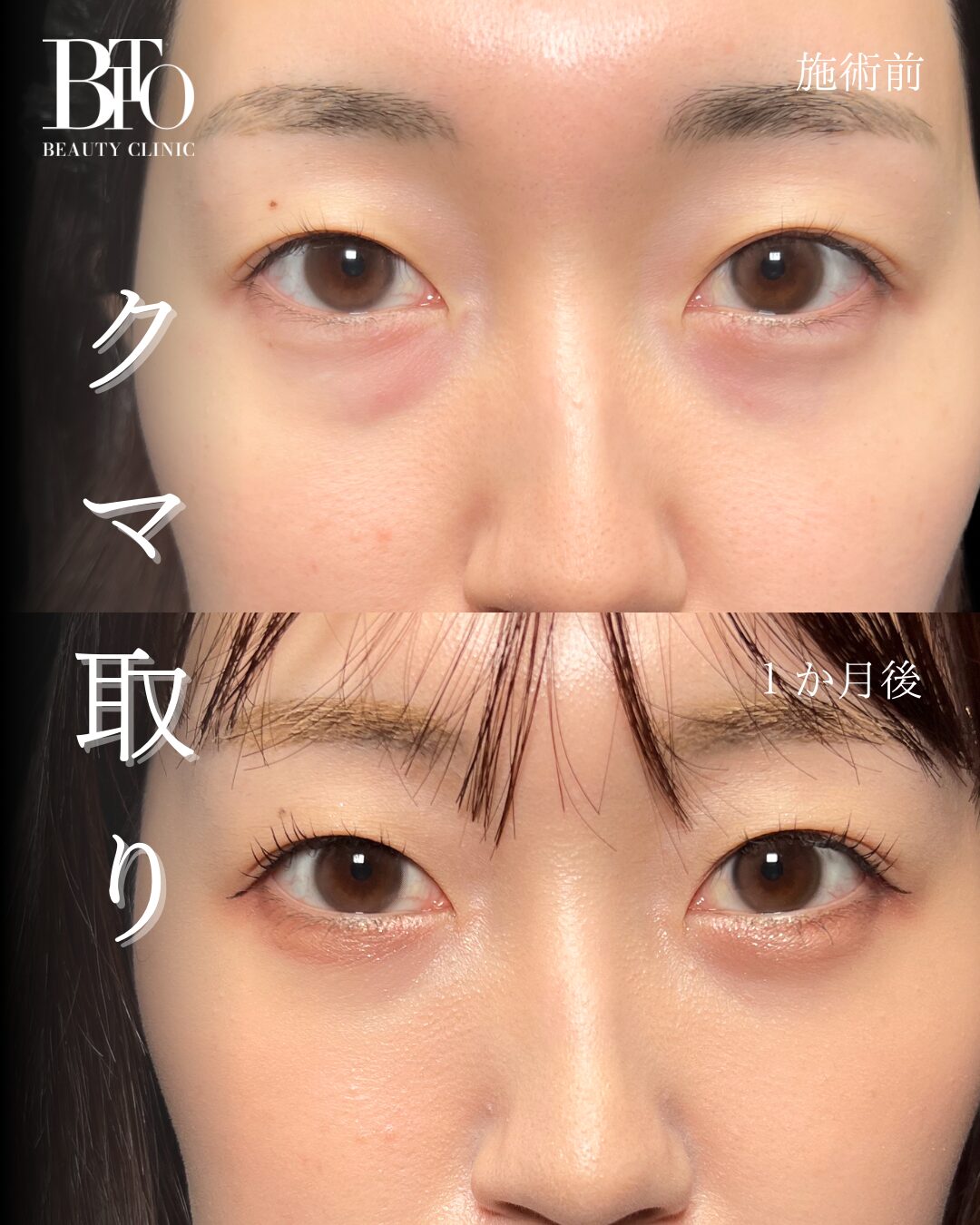 264.20代女性 切らないクマ取り(脱脂術)
