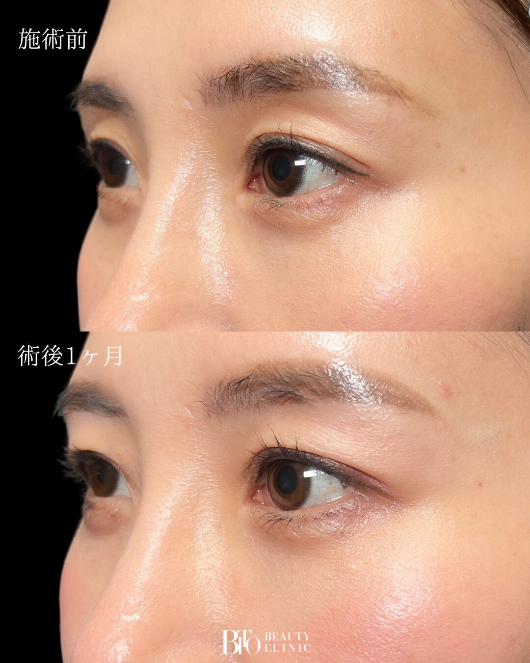 271.40代女性 くぼみ目のヒアルロン酸注入