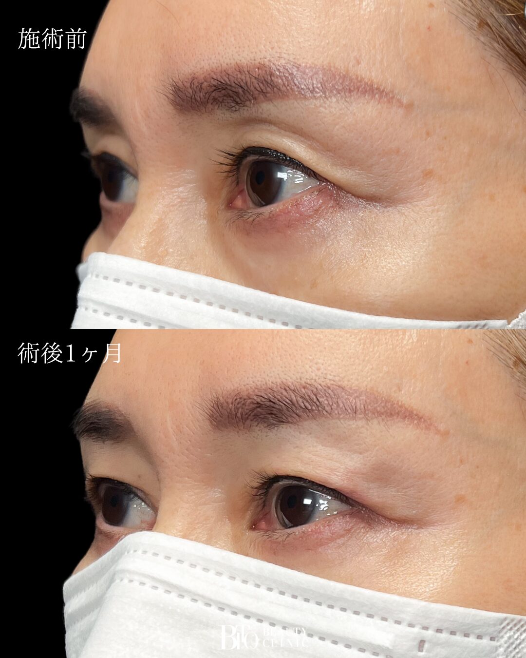 272.50代女性 くぼみ目のヒアルロン酸注入