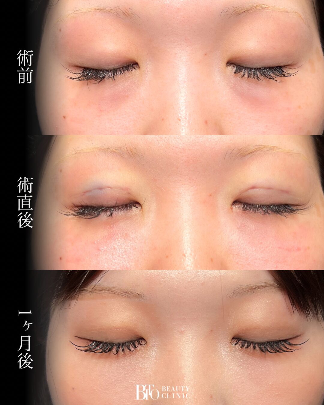 274.20代女性 切らないクマ取り(脱脂術)・二重埋没