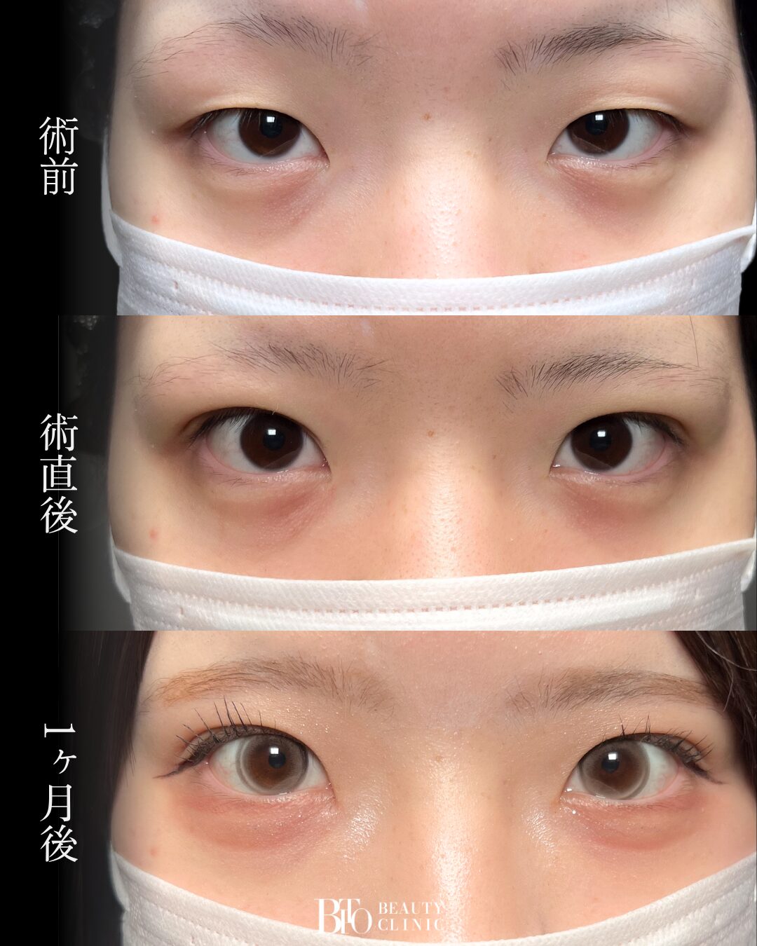 276.20代女性 二重埋没法