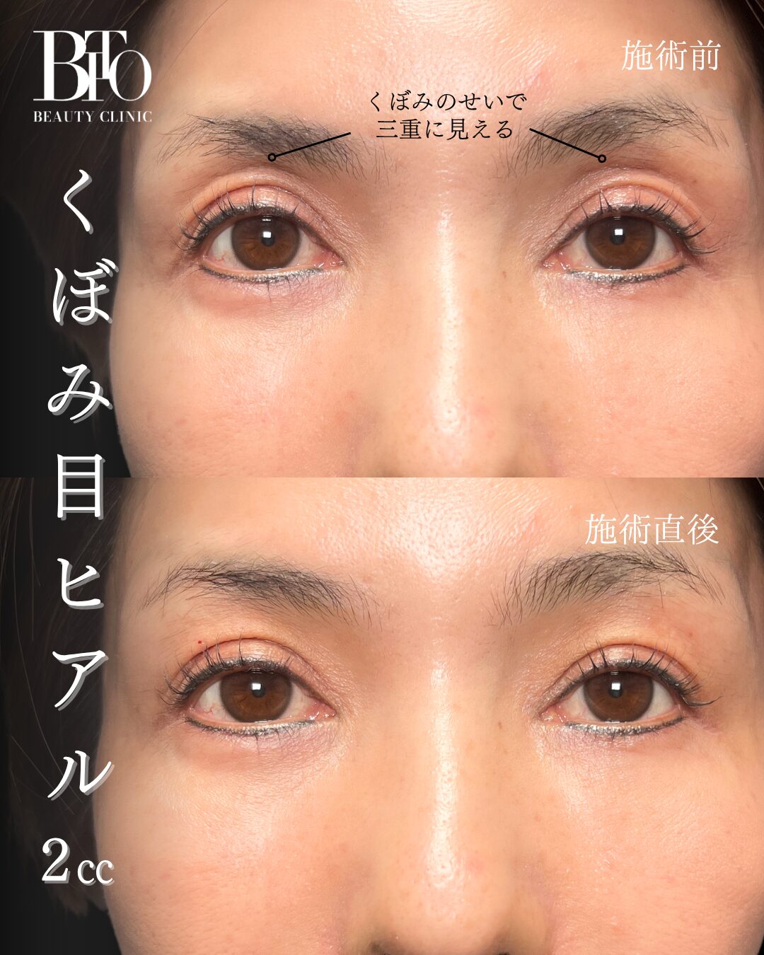 266.くぼみ目のヒアルロン酸注入