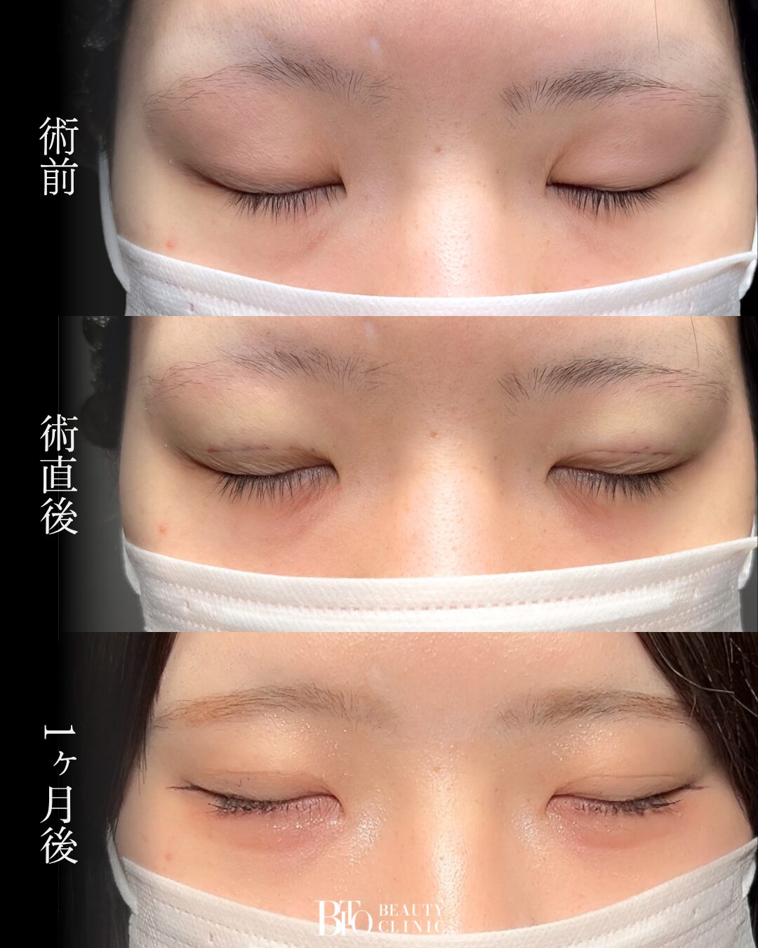 276.20代女性 二重埋没法