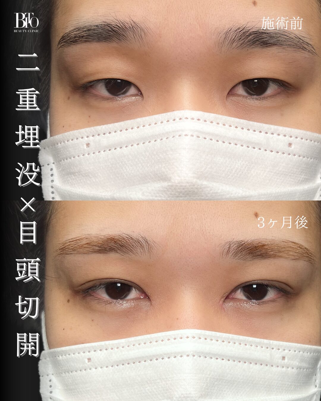 269. 20代男性 二重埋没・目頭切開