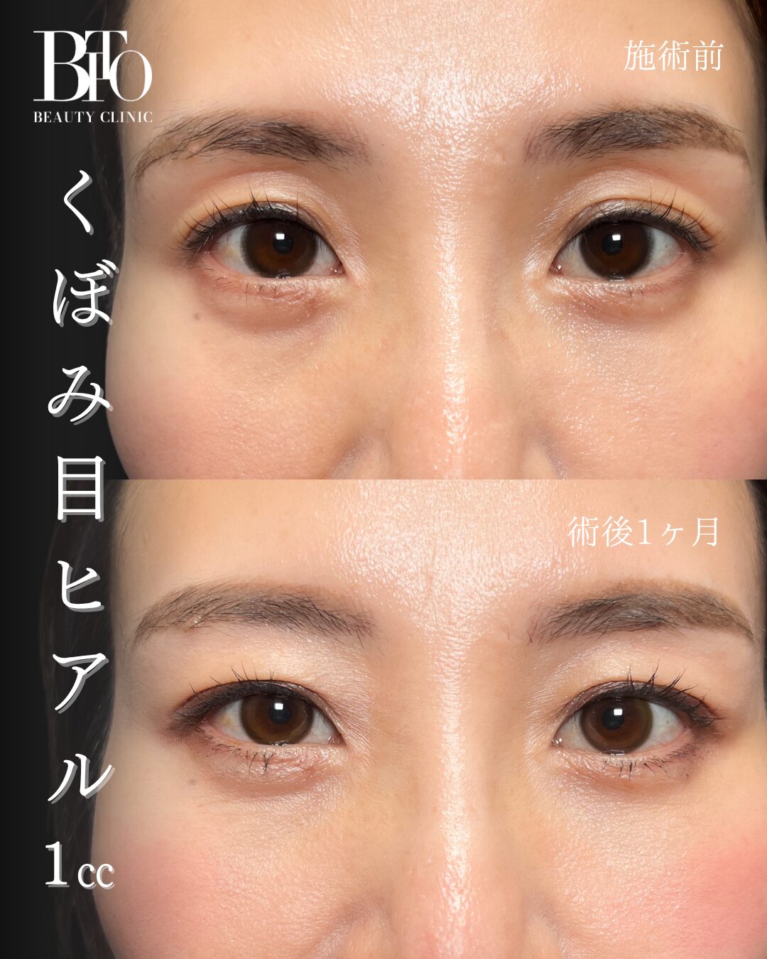 271.40代女性 くぼみ目のヒアルロン酸注入