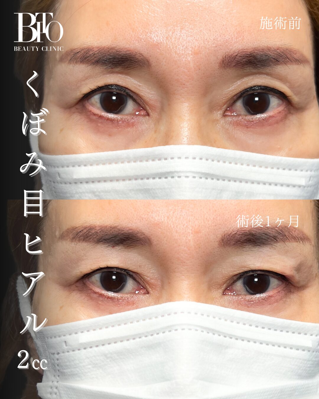 272.50代女性 くぼみ目のヒアルロン酸注入