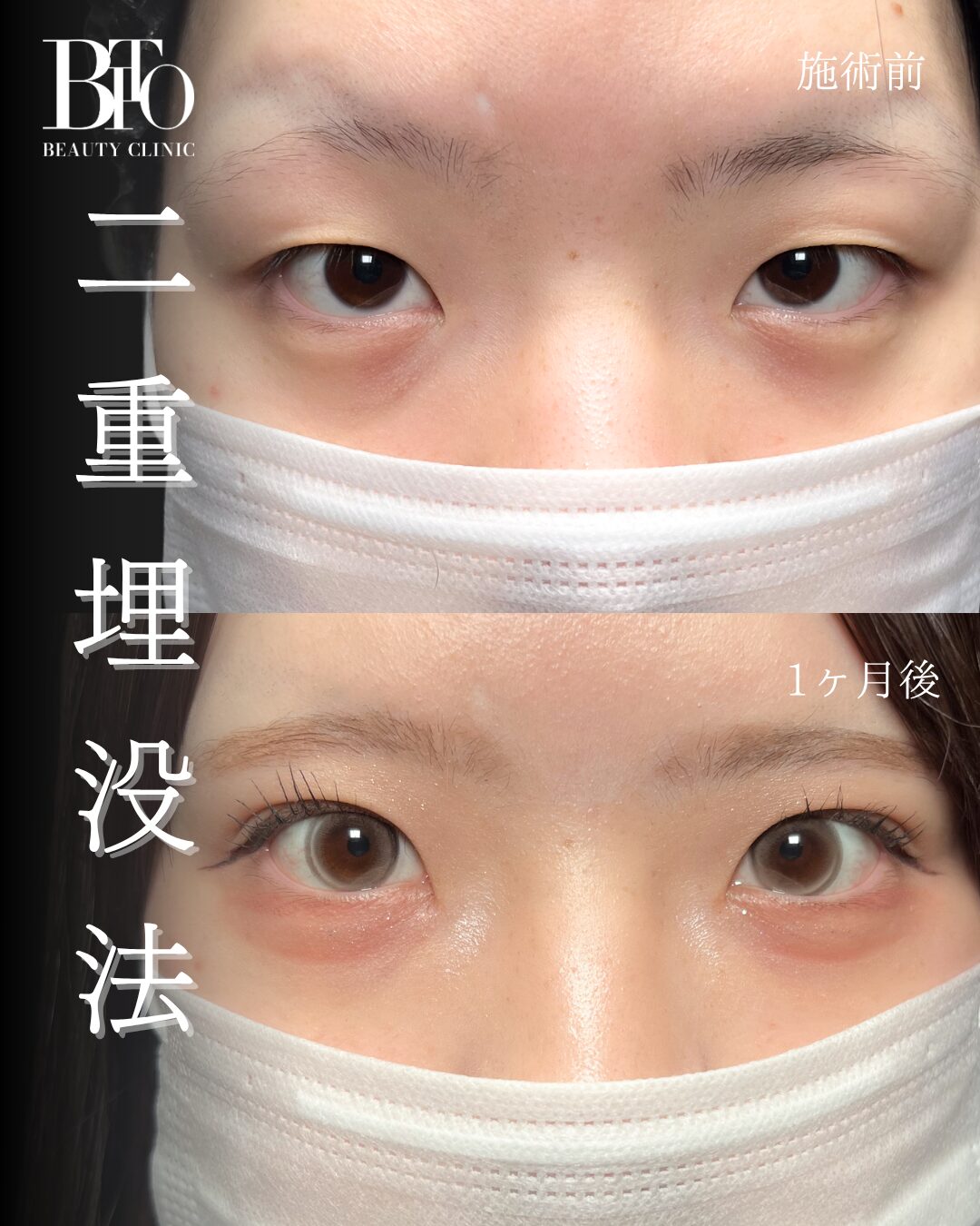 276.20代女性 二重埋没法