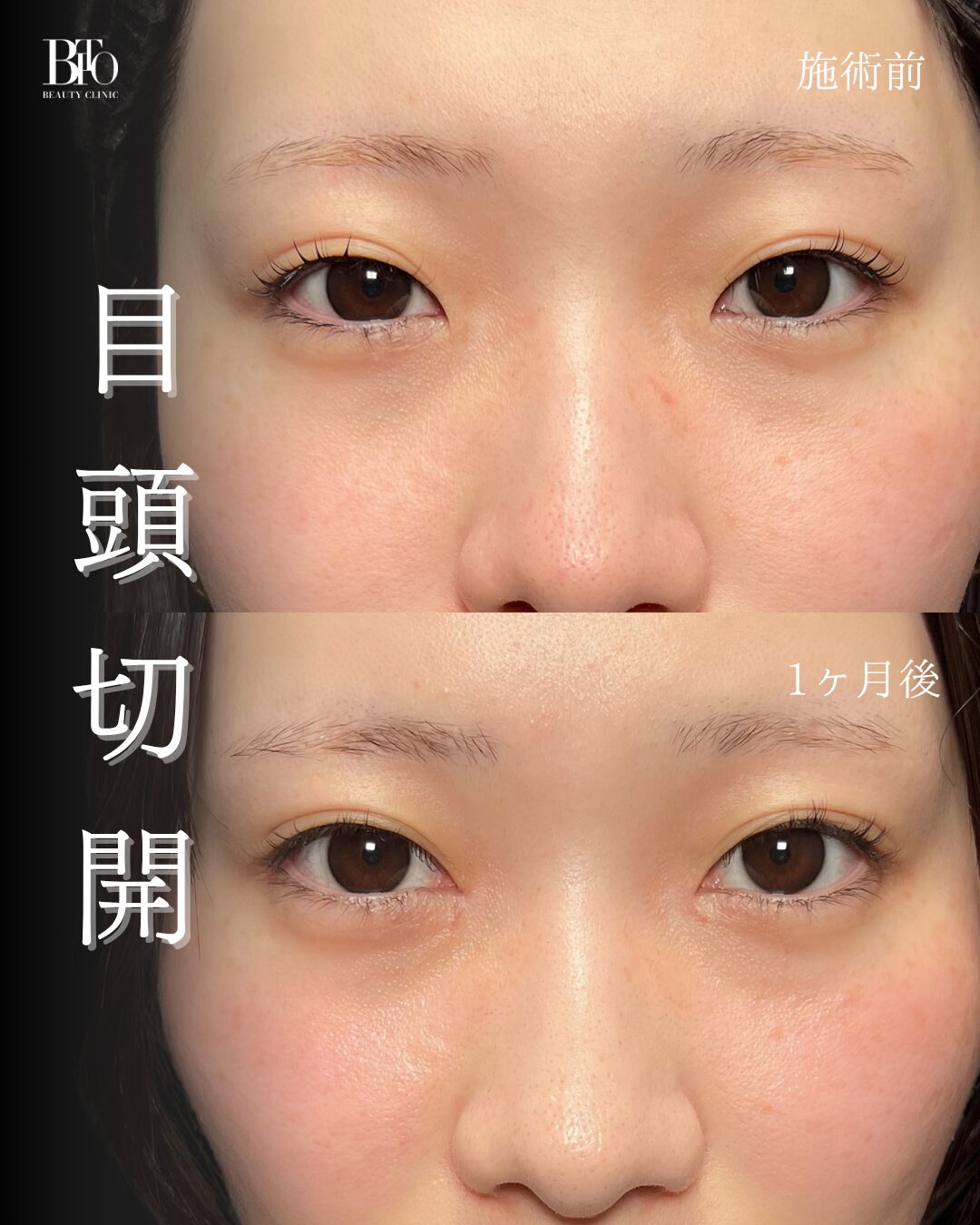 278.20代女性 目頭切開