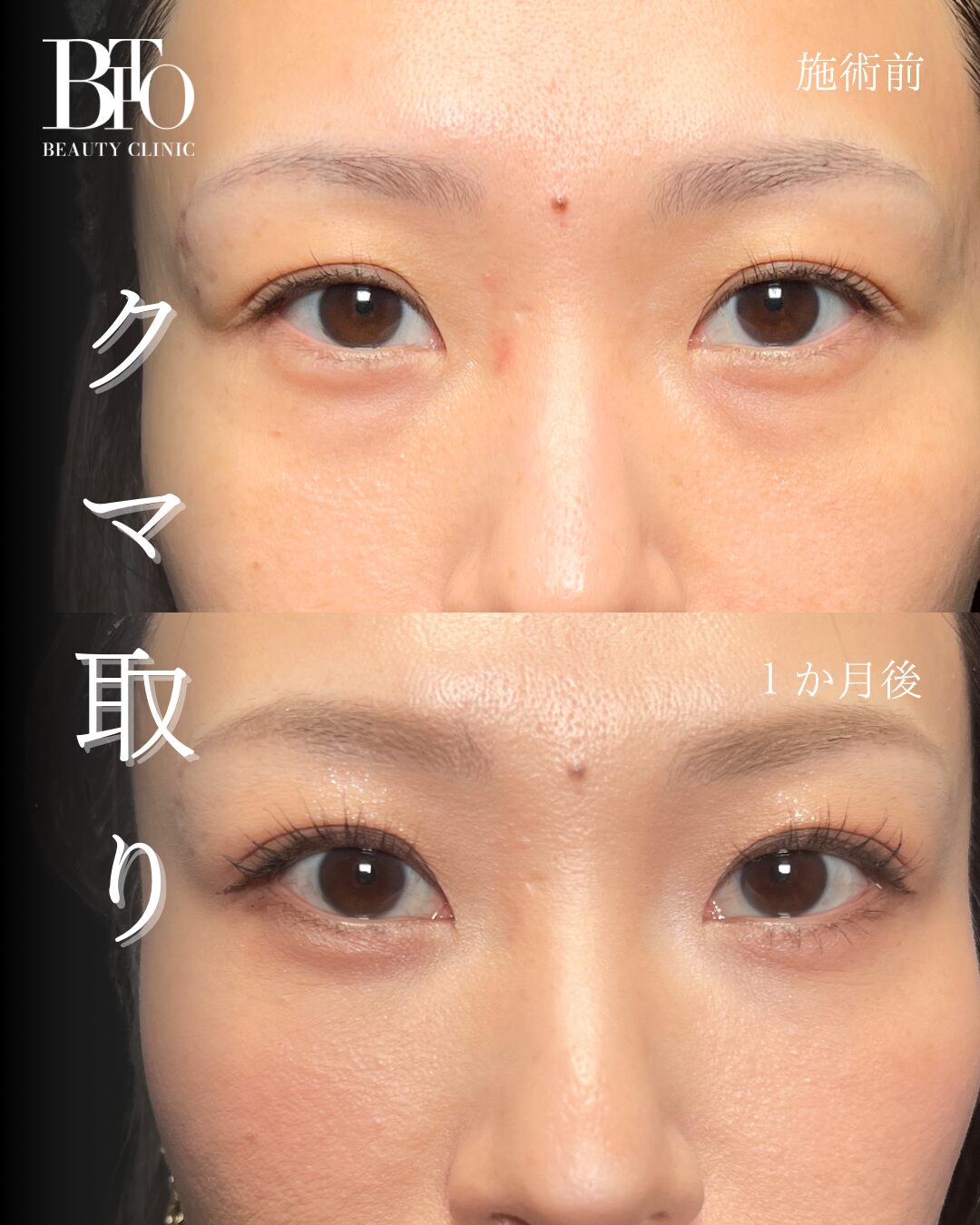 263.30代女性 切らないクマ取り(脱脂術)